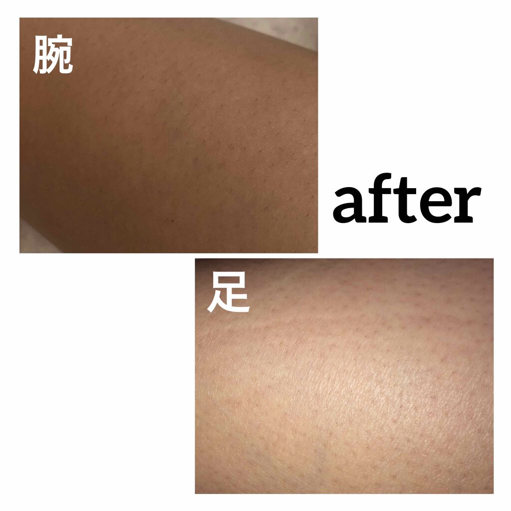 beyda IPL光脱毛器/beyda/家庭用脱毛器を使ったクチコミ（2枚目）