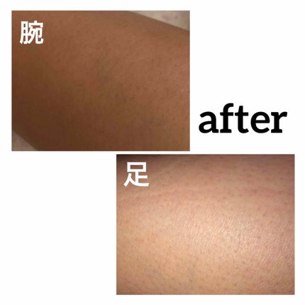 beyda IPL光脱毛器/beyda/家庭用脱毛器を使ったクチコミ(2枚目)