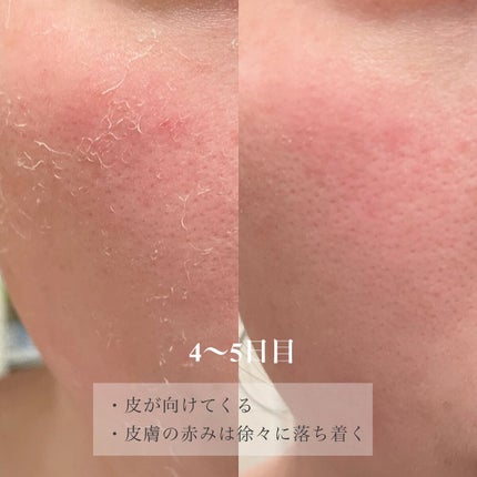 ダーマスキンピーリング/BQCELL/その他キットセットを使ったクチコミ(6枚目)