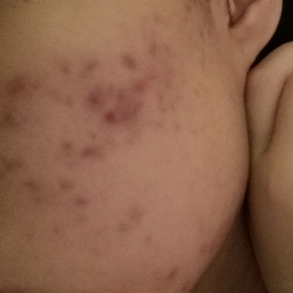 ペアアクネクリームW(医薬品)/ペア/その他を使ったクチコミ（2枚目）