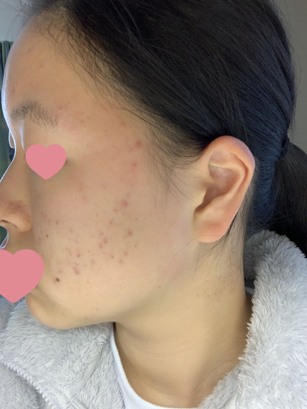 ペアアクネクリームW(医薬品)/ペア/その他を使ったクチコミ（2枚目）