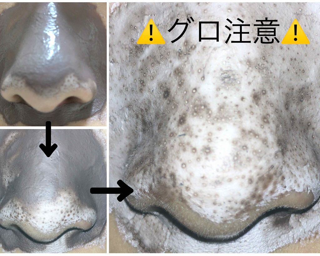 ツルリ 皮脂吸い出し 部分用パック ガスール＆レッドパワー/ツルリ/洗い流すパック・マスクを使ったクチコミ（3枚目）