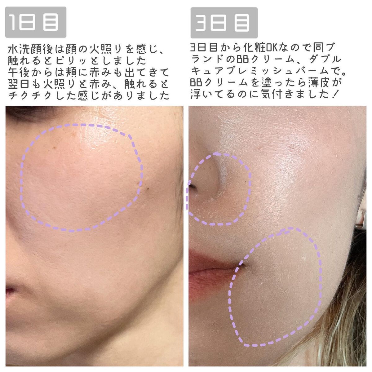 ダーマスキンピーリング/BQCELL/その他キットセットを使ったクチコミ（3枚目）