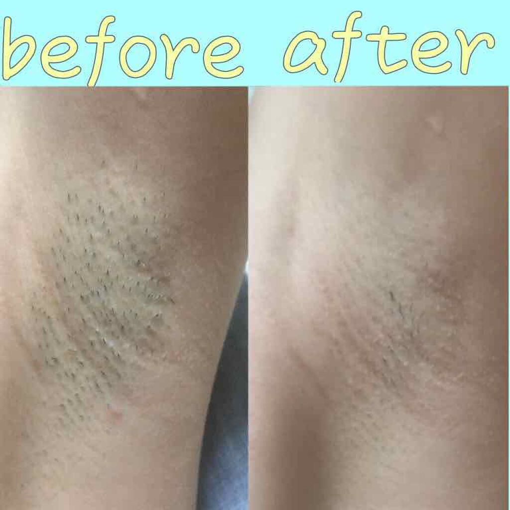 光美容器KE-NON(ケノン)/エムテック/家庭用脱毛器を使ったクチコミ(3枚目)