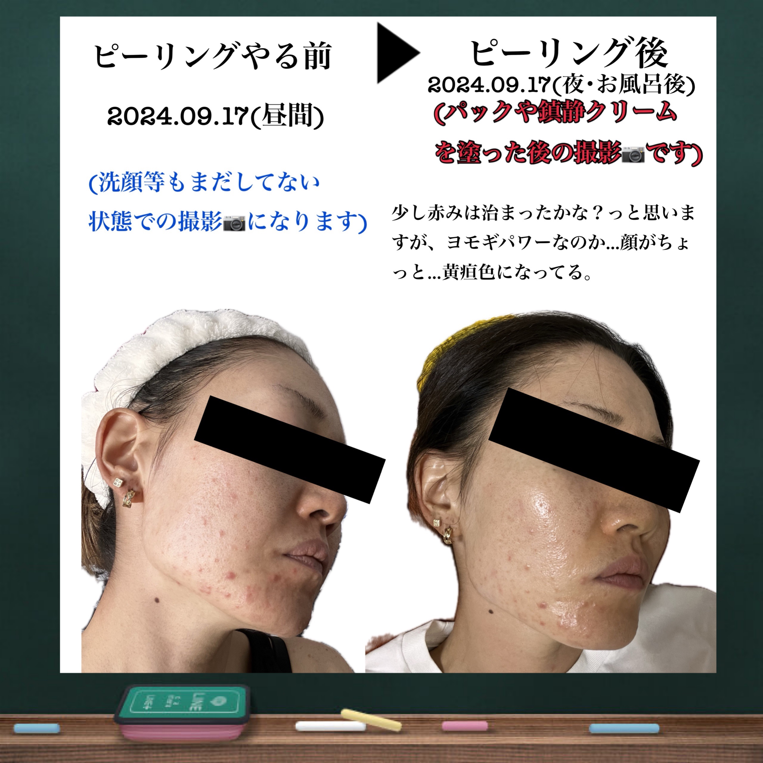 プレミアムシカトリートメントフィッティングマスクパック/WellDerma/シートマスク・パックを使ったクチコミ（2枚目）