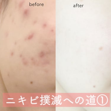 こ む ぎ on LIPS 「【🌼ニキビ撲滅への道　その①】ニキビって本当に厄介ですよね😭治..」（1枚目）