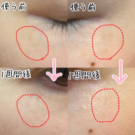ãã©ãããµã é
ž6ïŒ
ã¯ãªãŒã /DERMA FACTORY/ãã§ã€ã¹ã¯ãªãŒã ã䜿ã£ãã¯ãã³ãïŒ3æç®ïŒ