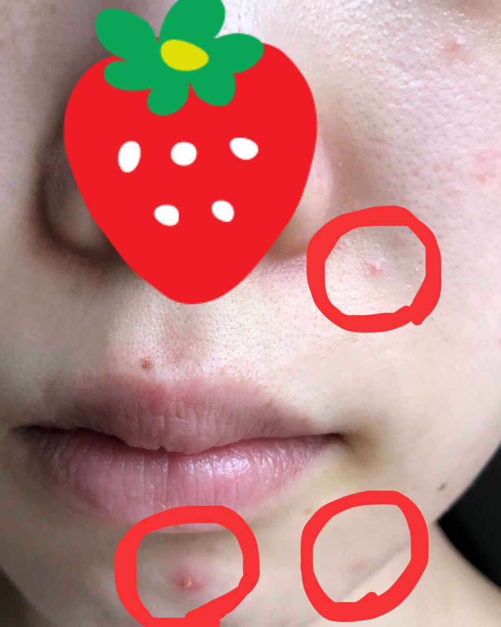 ゼロスポットパッチ/Today’s Cosme/にきびパッチを使ったクチコミ（3枚目）