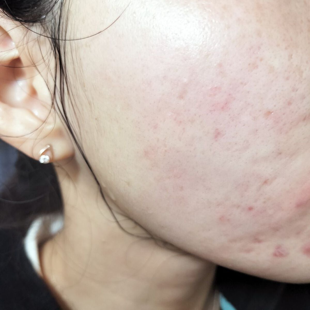 miina@汚肌工事録⚠️ on LIPS 「✍12/3の#汚肌工事録ありがとう💕きょうもおつかれさまだよ😂..」(1枚目)