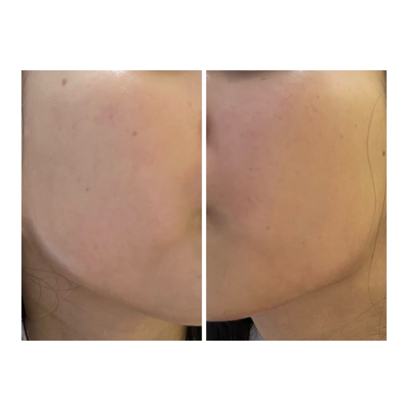 ぽむ on LIPS 「2023.9.13皮膚科に受診 エピデュオとヘパリン処方1枚目..」(4枚目)