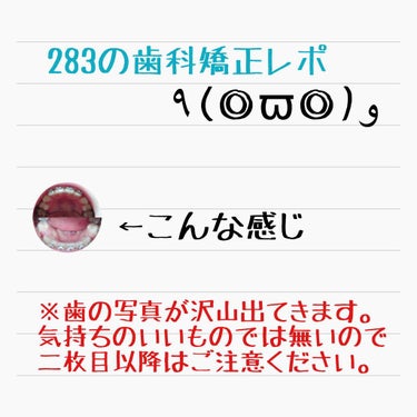 こんばんは٩(◎ϖ◎)    283空港です！

皆さんは自分の歯並びに自信ありますか？

私は全然なくて去年から自分でお金を貯めて歯科矯正を始めました！
あと2ヶ月で歯科矯正を始めて1年になります。(