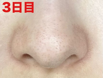 薬用 しみ 集中対策 美容液/メラノCC/美容液を使ったクチコミ(5枚目)