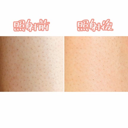 光美容器KE-NON(ケノン)/エムテック/家庭用脱毛器を使ったクチコミ(3枚目)