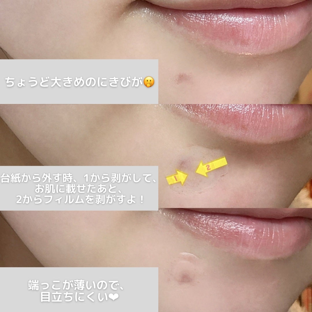 キャッチミーパッチ/CATCH ME PATCH/にきびパッチを使ったクチコミ(5枚目)