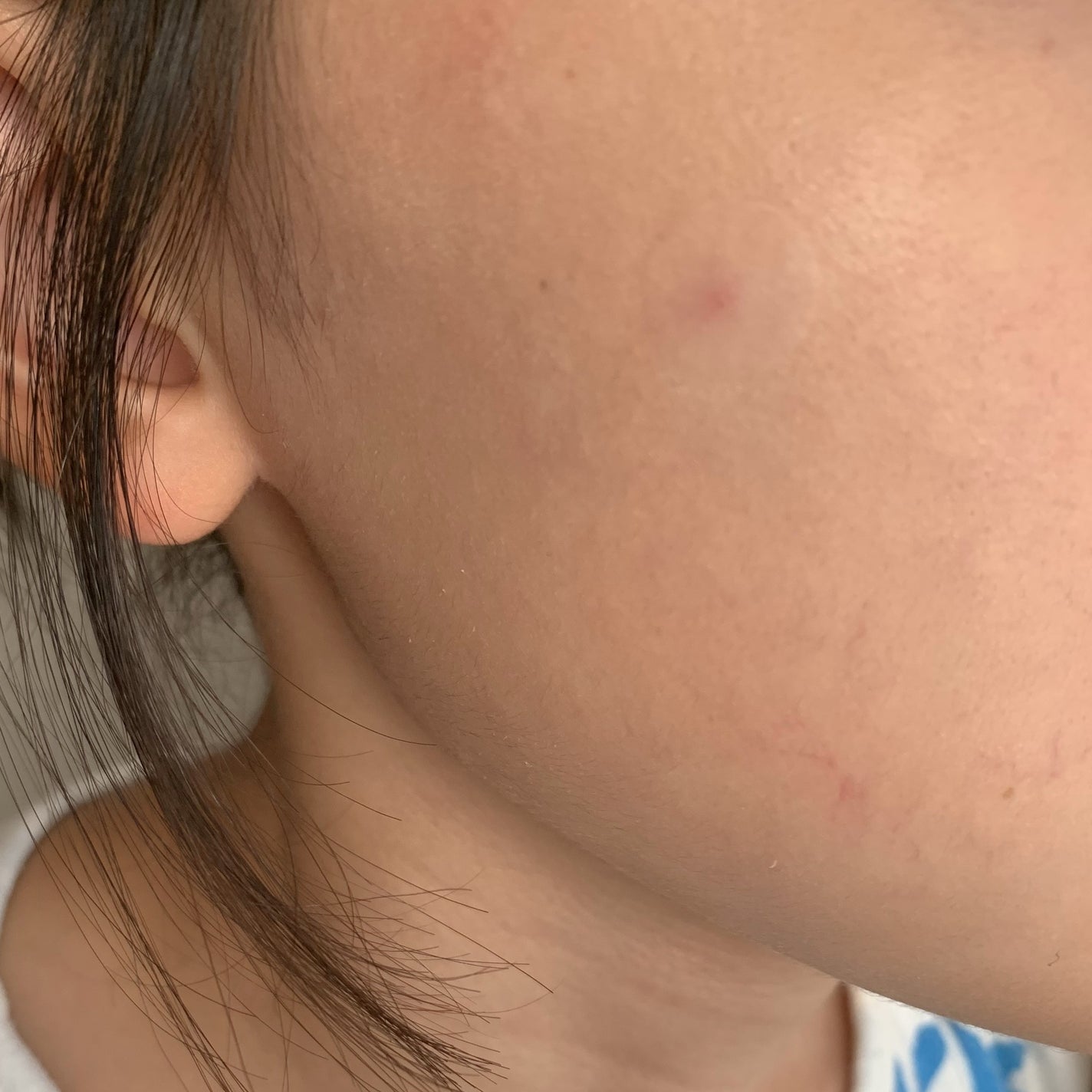 極薄透明パッチ nikipa!/金冠堂/にきびパッチを使ったクチコミ(7枚目)