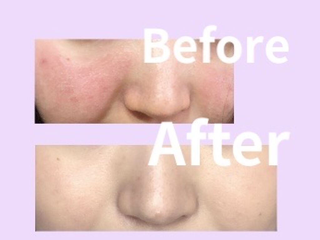 【旧】ディオールスキン フォーエヴァー スキン コレクト コンシーラー 1N ニュートラル/Dior/リキッドコンシーラーを使ったクチコミ（2枚目）