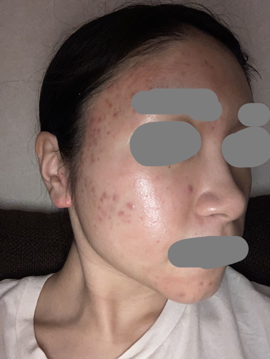 ベピオゲル/マルホ株式会社/その他を使ったクチコミ（2枚目）