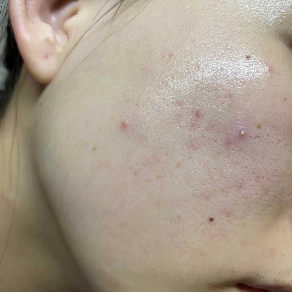 fresh_lips_rmq on LIPS 「5/18ぽちぽちできては消える..」(1枚目)