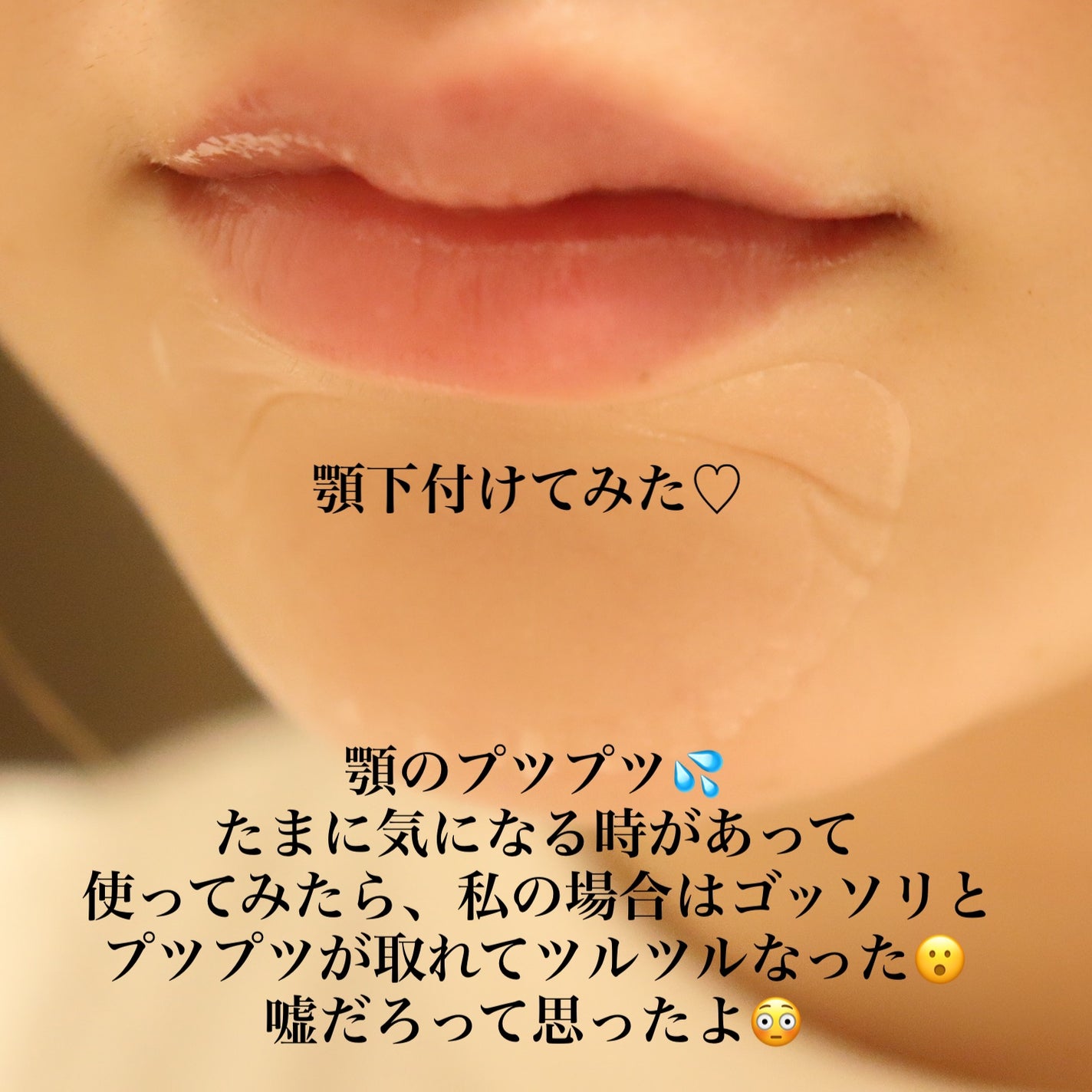 ゼロスポットパッチ/Today’s Cosme/にきびパッチを使ったクチコミ(3枚目)