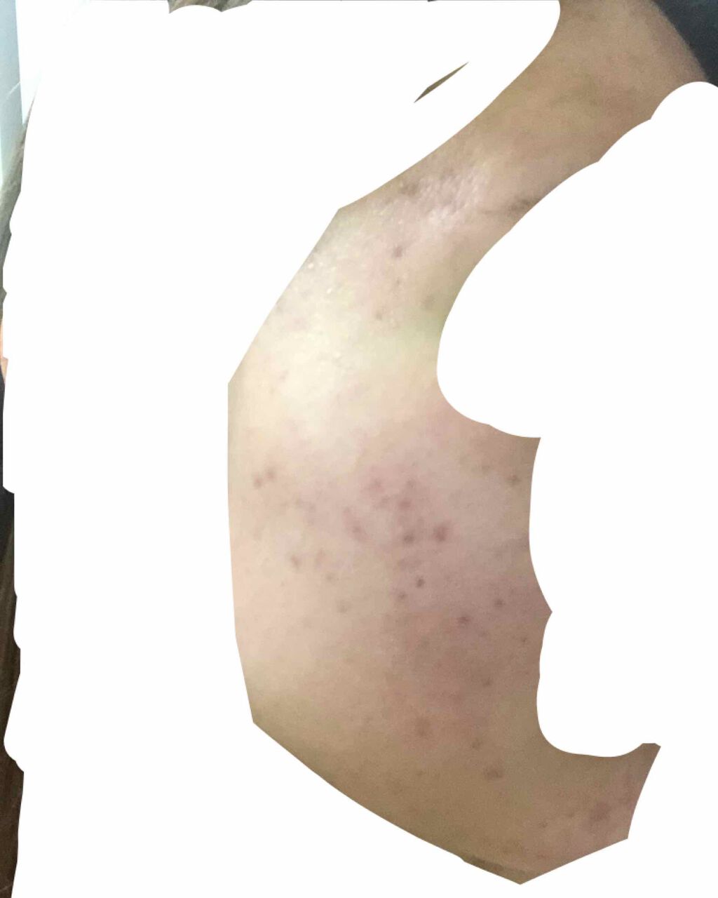 ななみ on LIPS 「ペピオゲル使用してから2ヶ月ちょっとが経ちました!ニキビ跡はし..」(1枚目)