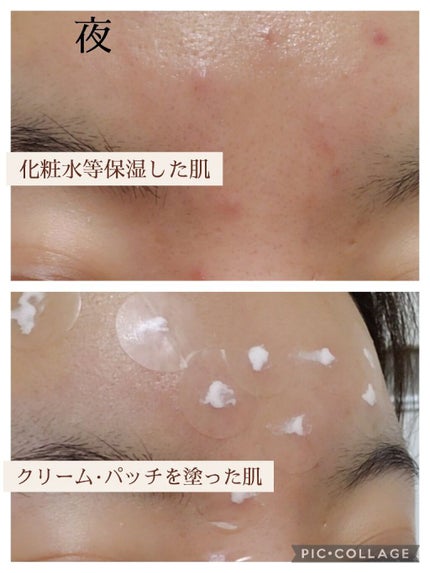 薬用ニキビケア スポッツクリーム/アクネスラボ/フェイスクリームを使ったクチコミ(6枚目)