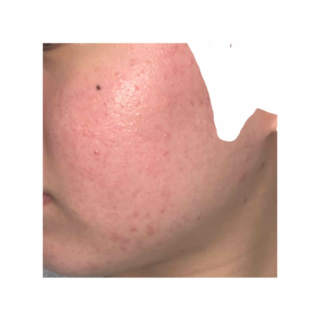 マシュマロホイップ 薬用アクネケア/ビオレ/泡洗顔を使ったクチコミ（2枚目）