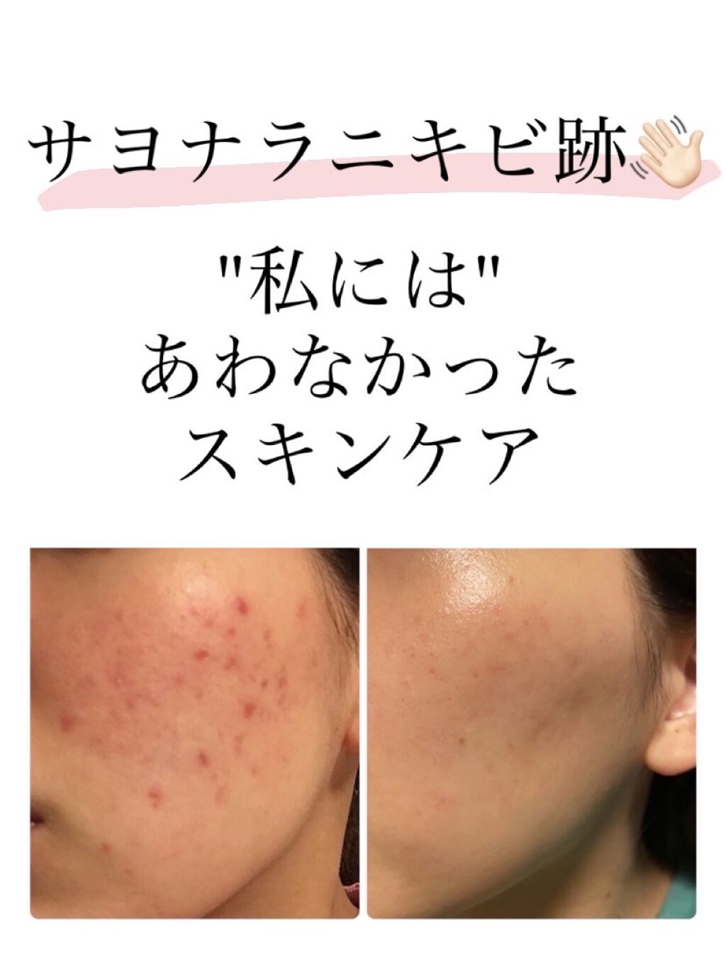 薬用 しみ 集中対策 美容液/メラノCC/美容液を使ったクチコミ（1枚目）