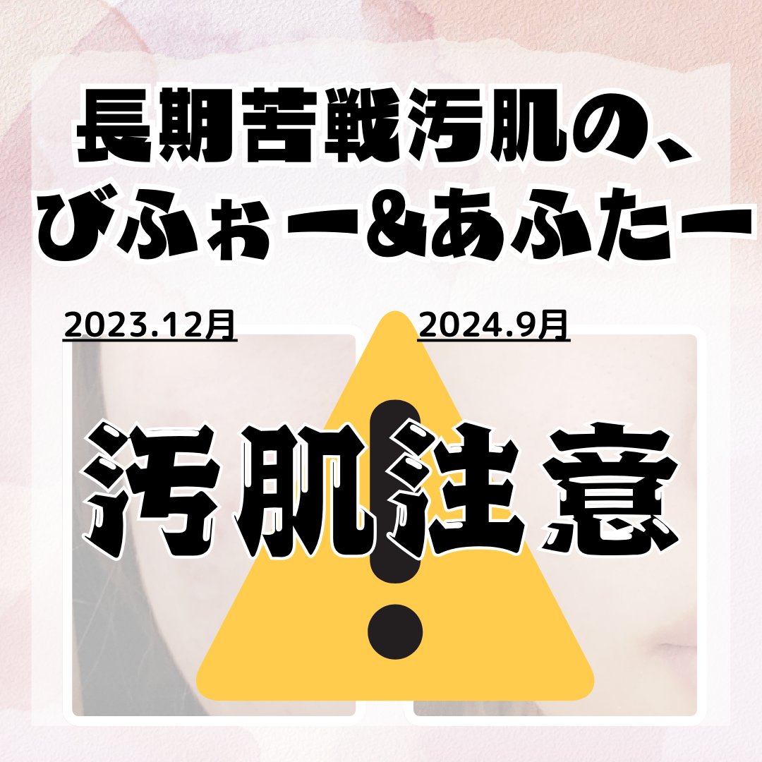 皮脂トラブルケア 保湿ジェル/キュレル/化粧水を使ったクチコミ（1枚目）