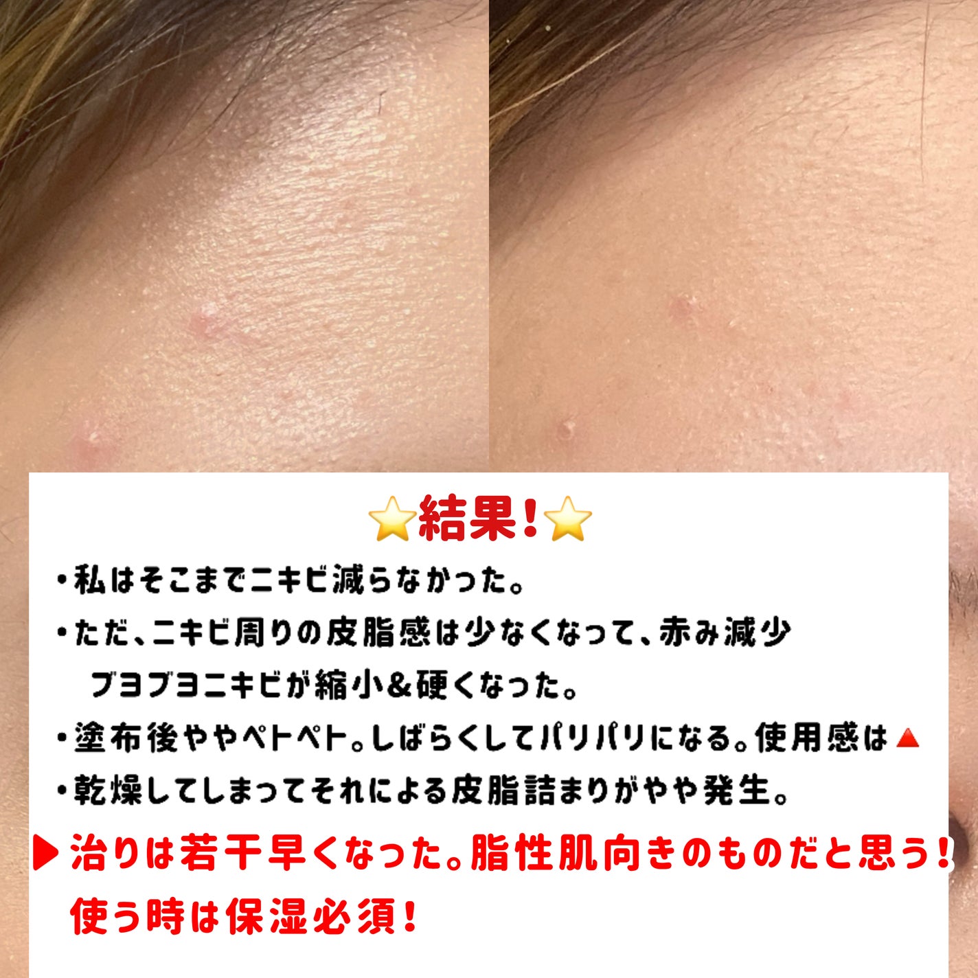 AZアゼライン酸10セラム/コスデバハ/美容液を使ったクチコミ(5枚目)