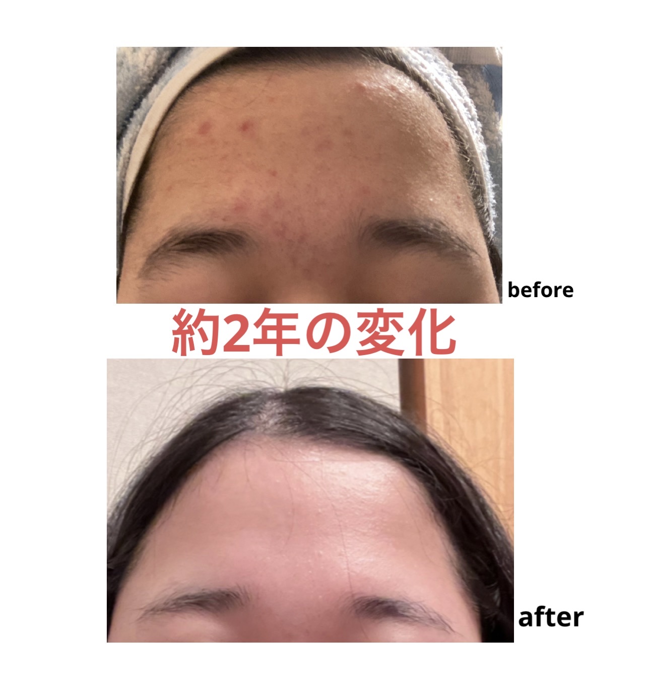 薬用洗顔フォーム/スキンライフ/洗顔フォームを使ったクチコミ（1枚目）