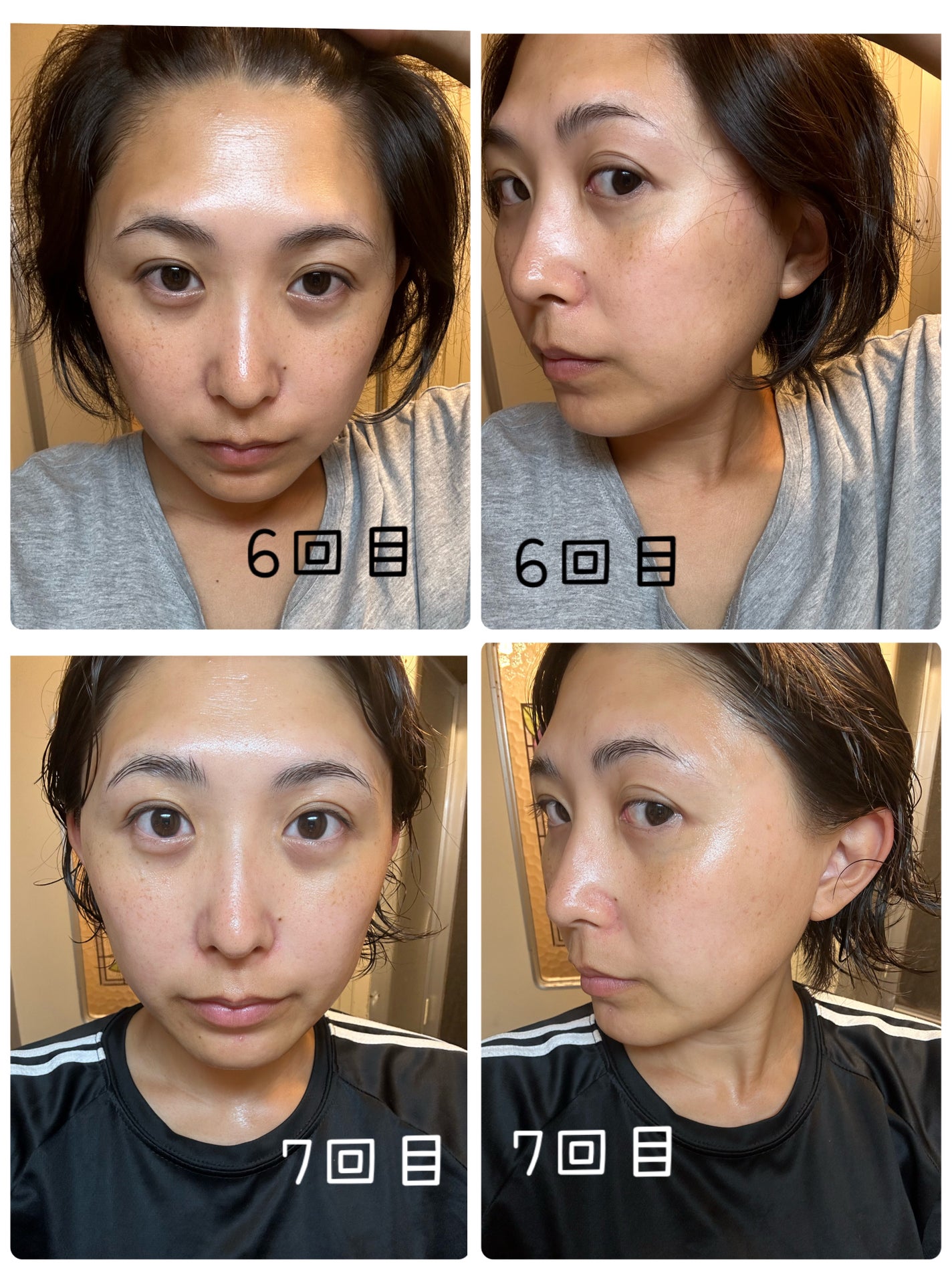 リマージ糸リフティングアンプル/REVENIP/美容液を使ったクチコミ(4枚目)