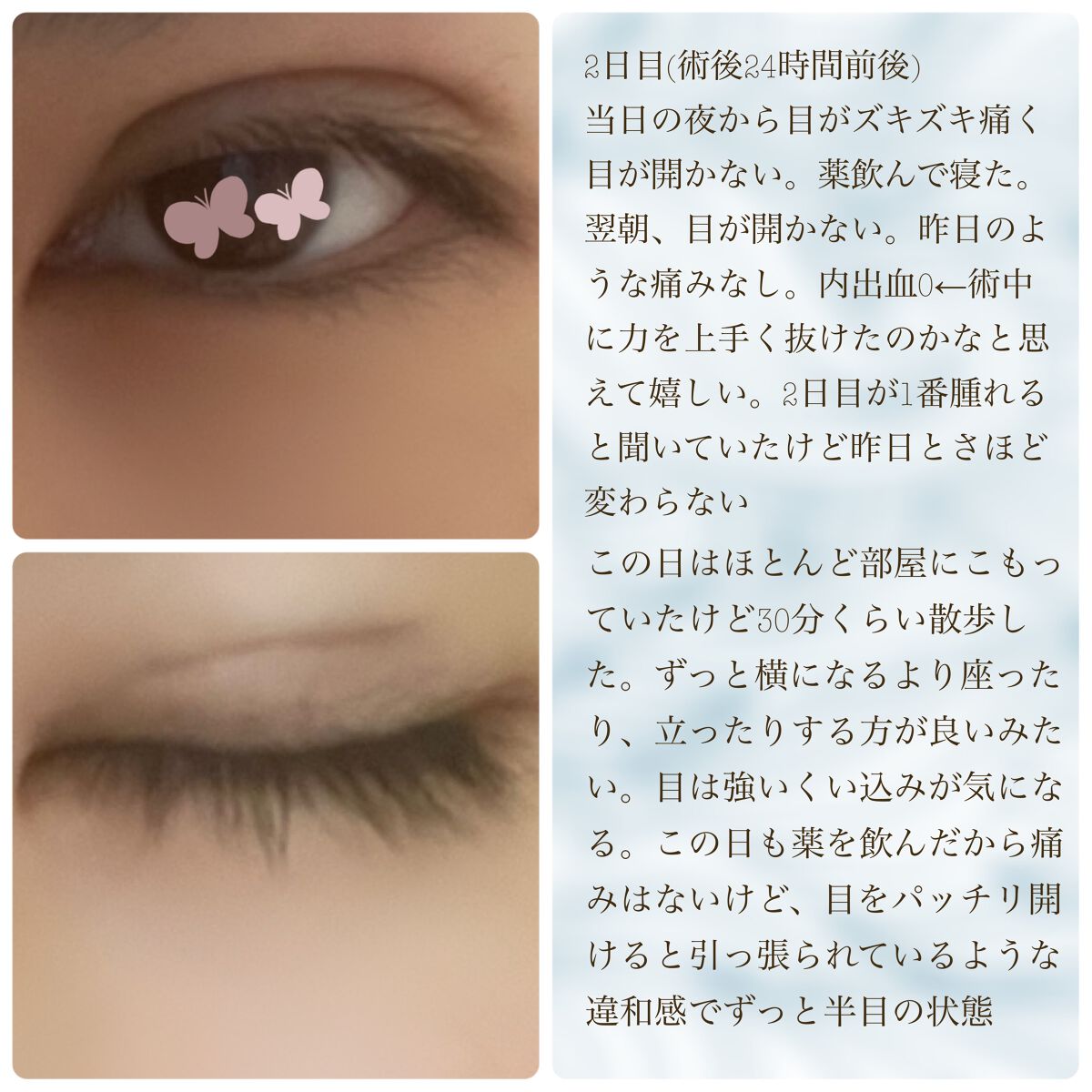 ◢͟│⁴⁶のおたく on LIPS 「⚠️目の写真がいっぱいあります⚠️湘南美容外科で埋没の整形をし..」(4枚目)