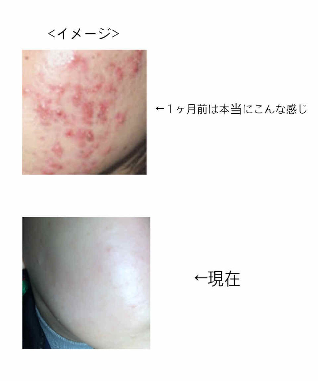 アクアチムローション、アクアチムクリーム(医薬品)/大塚製薬/その他を使ったクチコミ（2枚目）