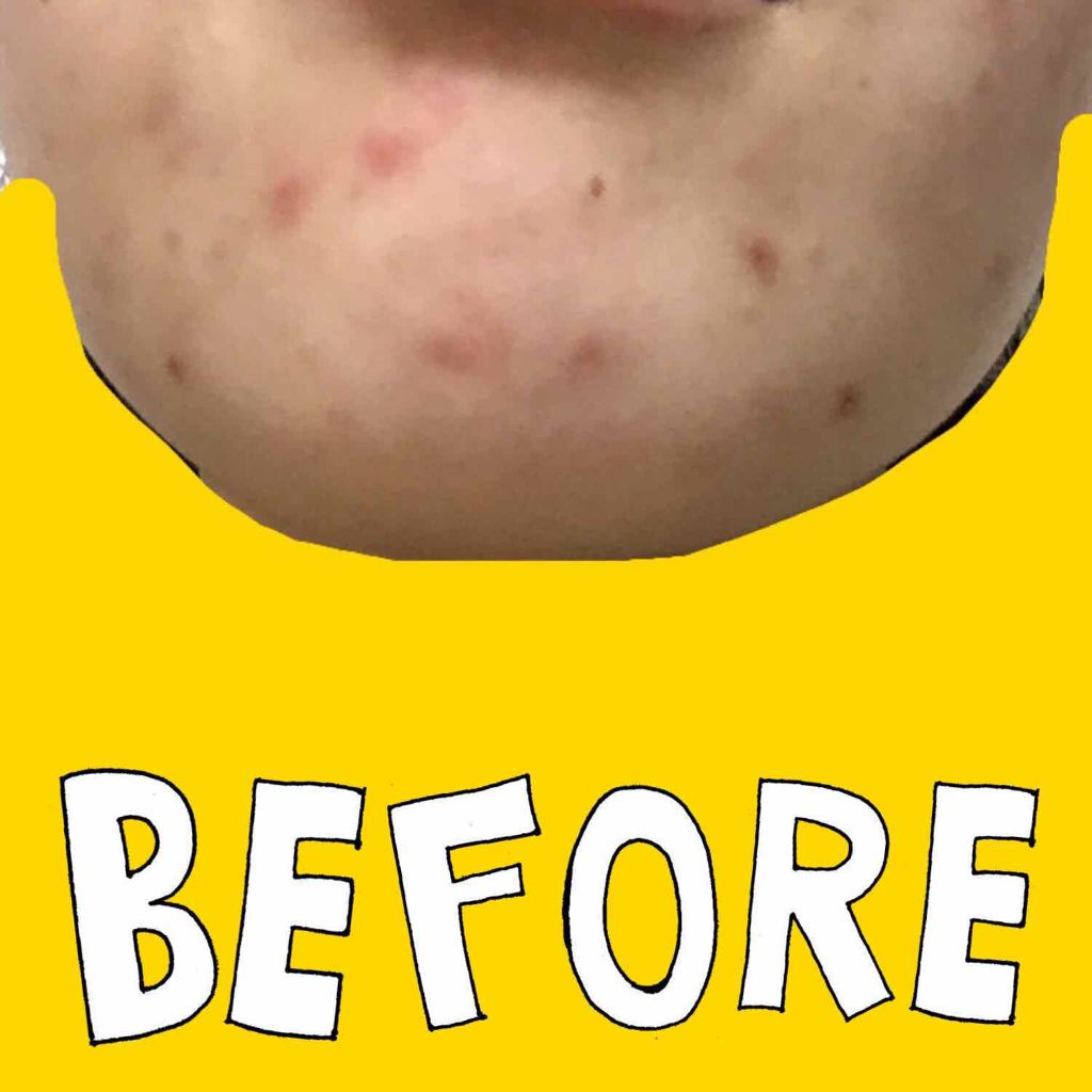 アクネケア セット N/d プログラム/トライアルキットを使ったクチコミ(2枚目)