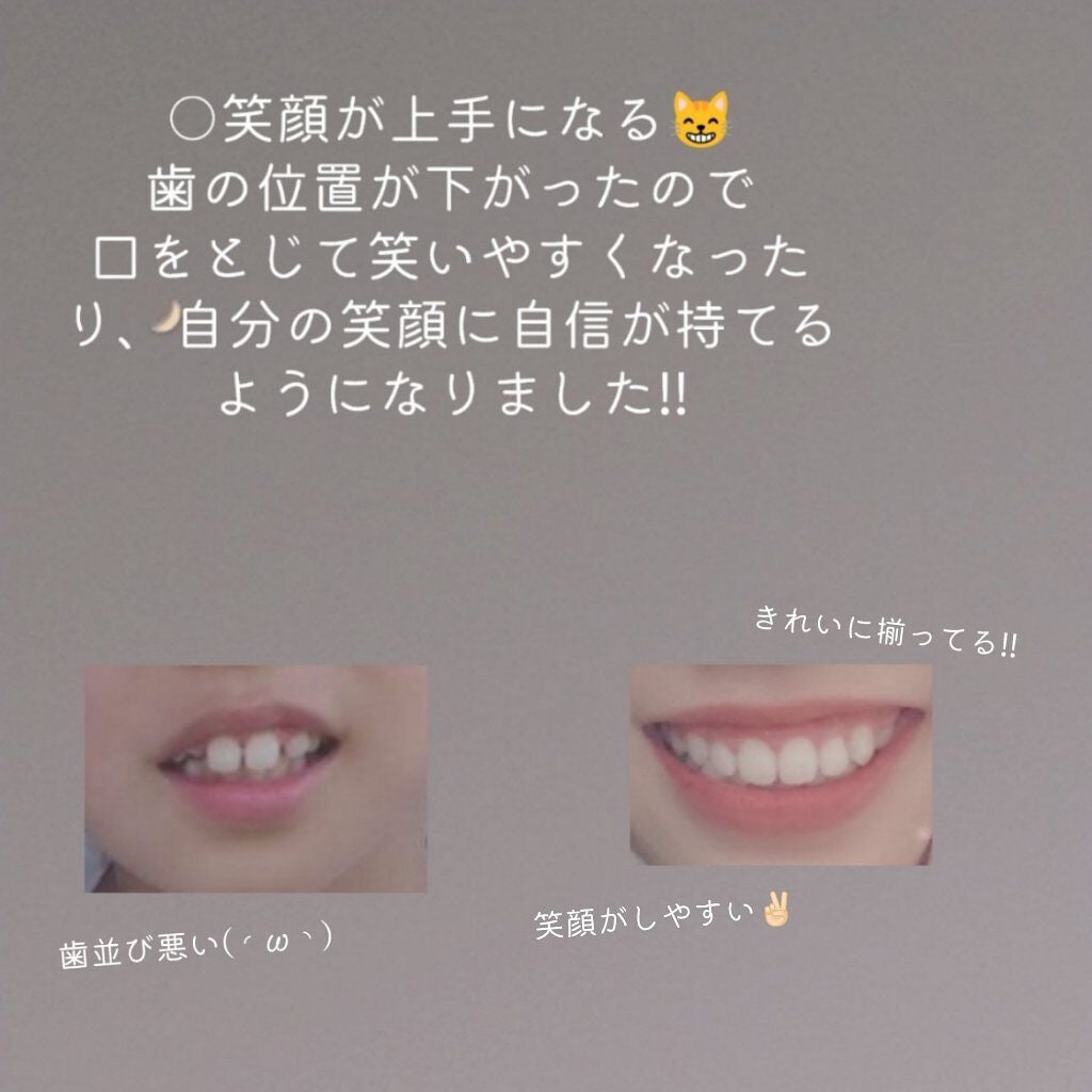 ま り on LIPS 「⸜歯科矯正をして良かったこと.⸝やっほっほ~~‼まりだよ~~✌..」(3枚目)