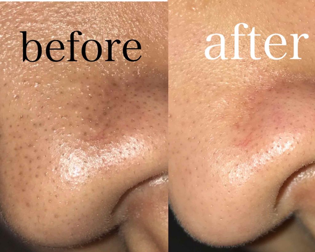 さかなのらく 美顔器 /BLAU HANDEL/美顔器・マッサージを使ったクチコミ（3枚目）