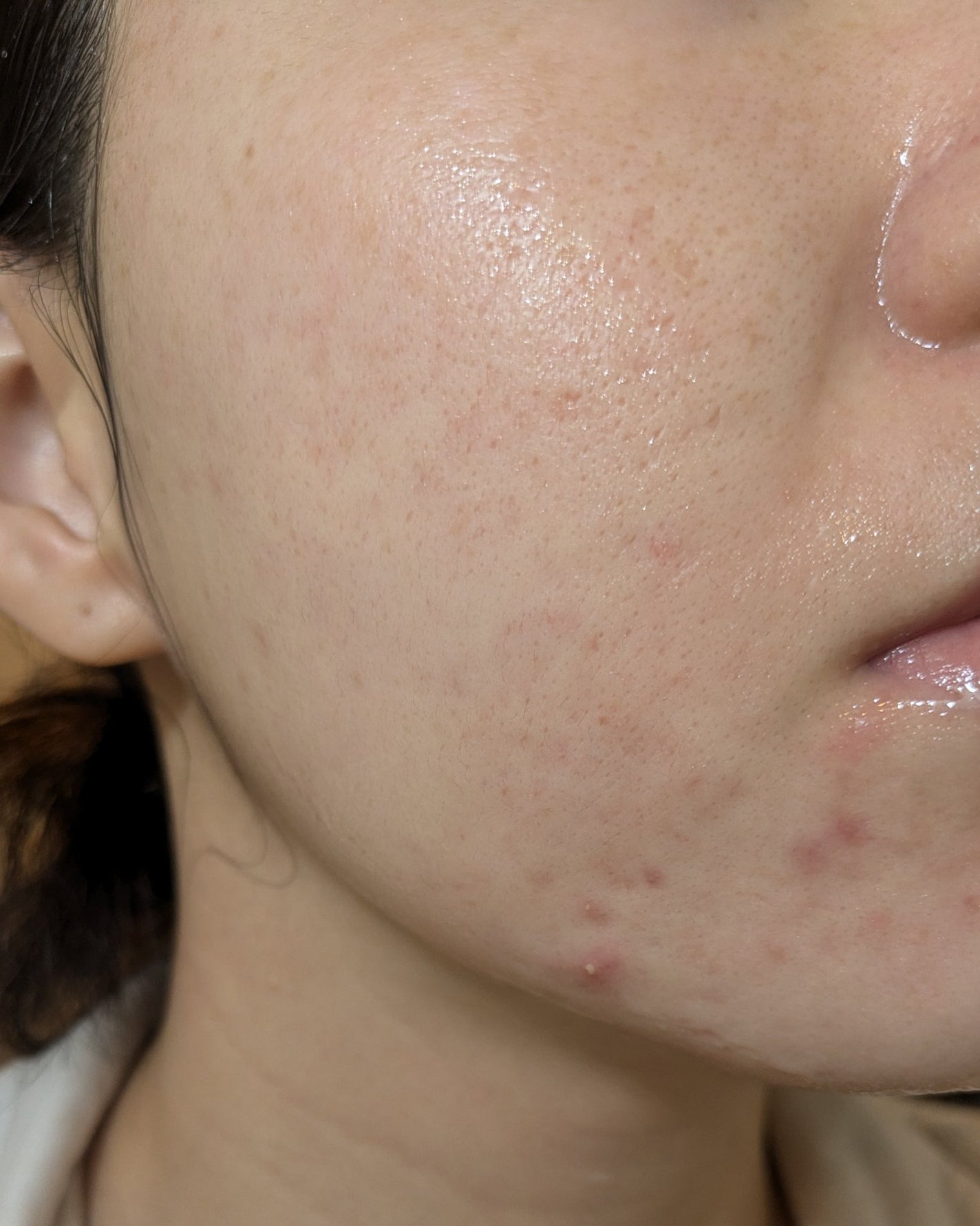 miina@汚肌工事録⚠️ on LIPS 「10/29の#汚肌工事録😂..」(1枚目)