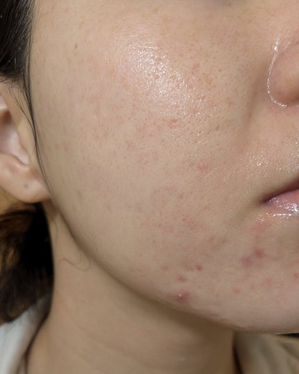 miina@汚肌工事録⚠️ on LIPS 「10/29の#汚肌工事録😂..」(1枚目)