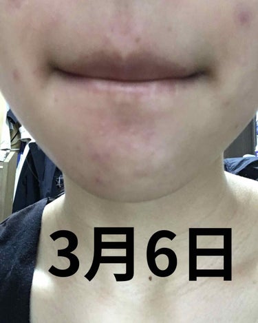 fresh_make_pac on LIPS 「大人ニキビにずっと悩んできて皮膚科に相談して、いろいろ試した結..」（3枚目）