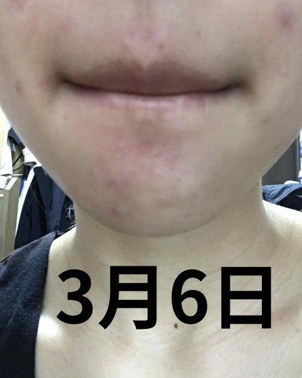 エピデュオゲル/マルホ株式会社/その他を使ったクチコミ(3枚目)