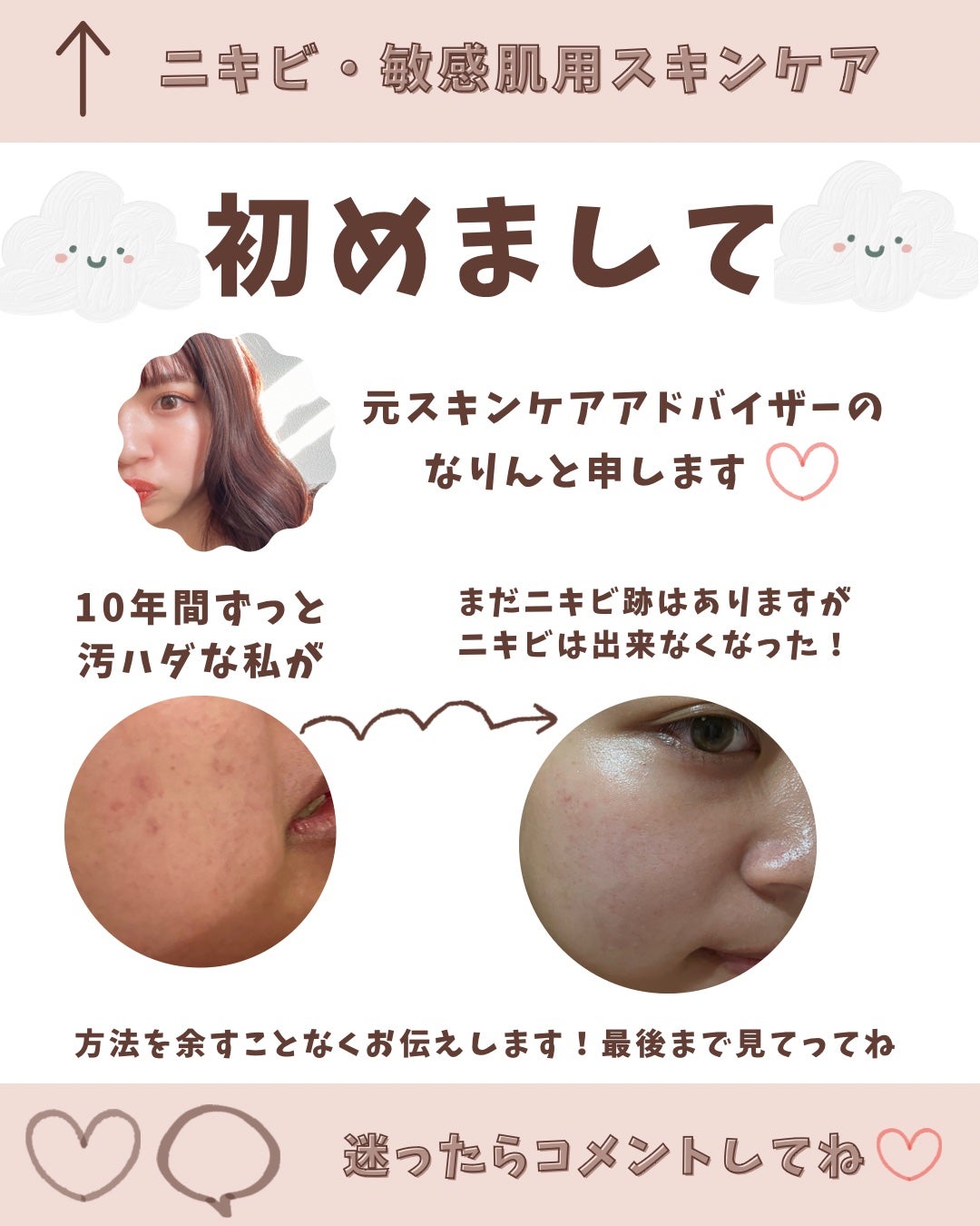 なりん ⋆⸜⋆⸜10年悩んだニキビ肌のなおし方⸝⋆⸝⋆ on LIPS 「記念すべき初投稿!見てくれた人ありがとう😊🩵🩵敏感.ニキビ肌で..」(2枚目)