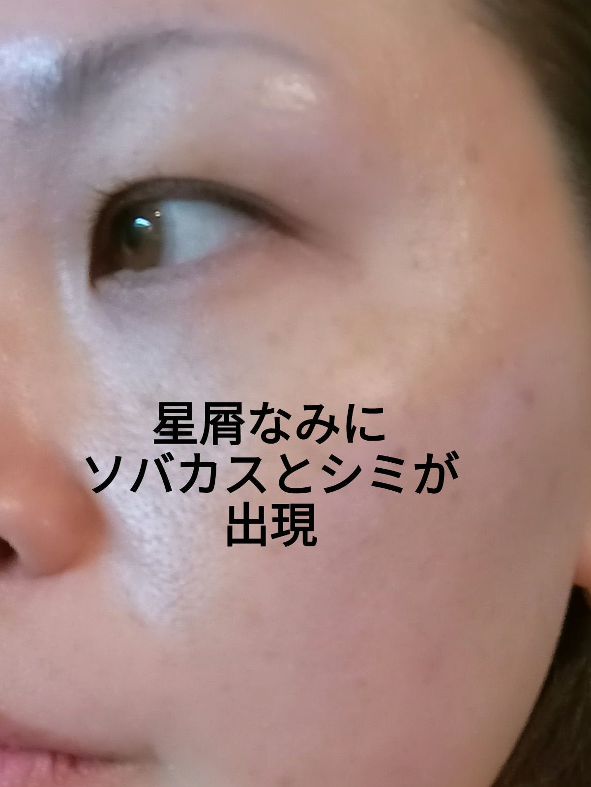 ビヨンセ奥二重向上委員長🥸LIPSパートナー🥳 on LIPS 「2回目フォトダブルに湘南美容クリニックに行ってきました!!看護..」(4枚目)