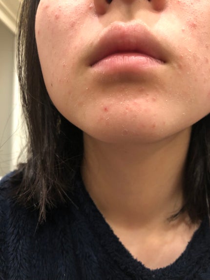 肌荒れ女子 on LIPS 「【閲覧注意⚠️】肌荒れ女子の肌断食日記📖2日目・・・・こんにち..」(6枚目)