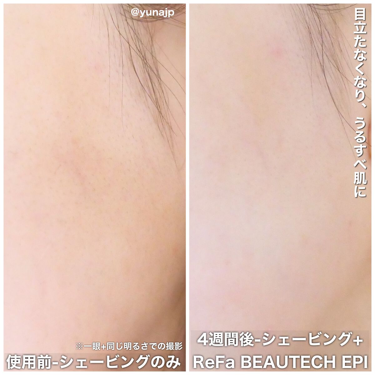 リファ ビューテックエピ/ReFa/家庭用脱毛器を使ったクチコミ(4枚目)