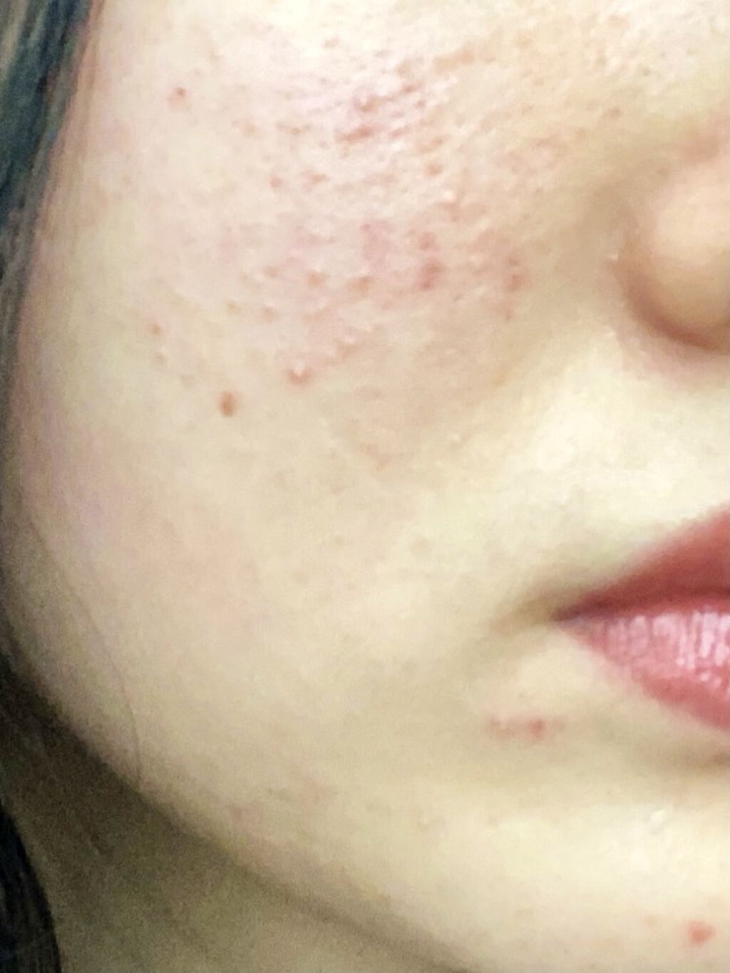 アクネケア エマルジョン R/d プログラム/乳液を使ったクチコミ（2枚目）