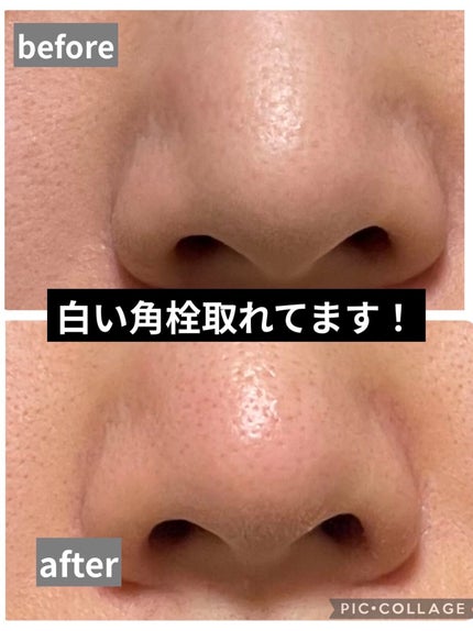 毛穴小町 イエローピールオフパック/クリアターン/ピーリングを使ったクチコミ(4枚目)