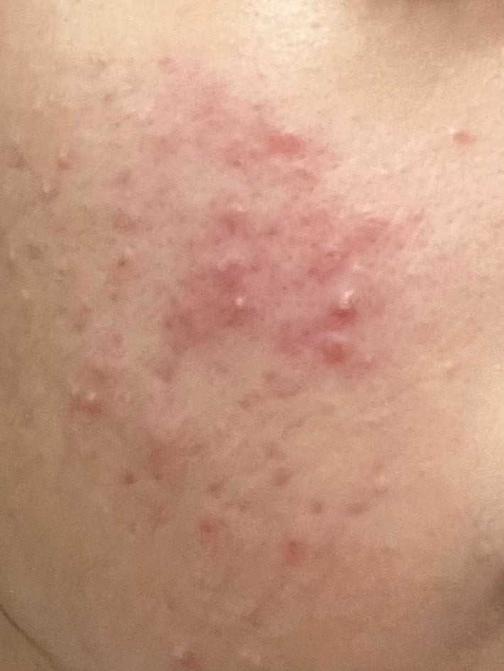 ゆゆ on LIPS 「ニキビ、沢山増えてしまいました泣一昨日皮膚科にやっと行き始めま..」(2枚目)