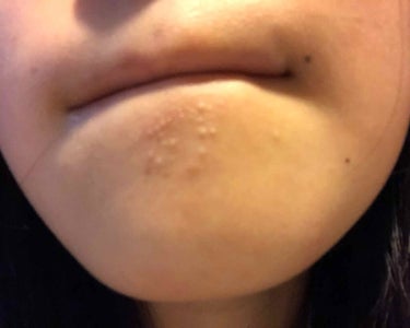 ミルミル on LIPS 「初投稿です○┓どなたか助けてください😭😭2枚目からは私の顎（？..」（2枚目）