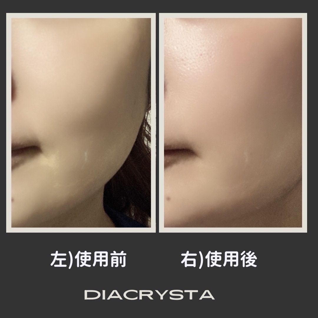 diacrysta　美顔器/diacrysta/美顔器・マッサージを使ったクチコミ（1枚目）