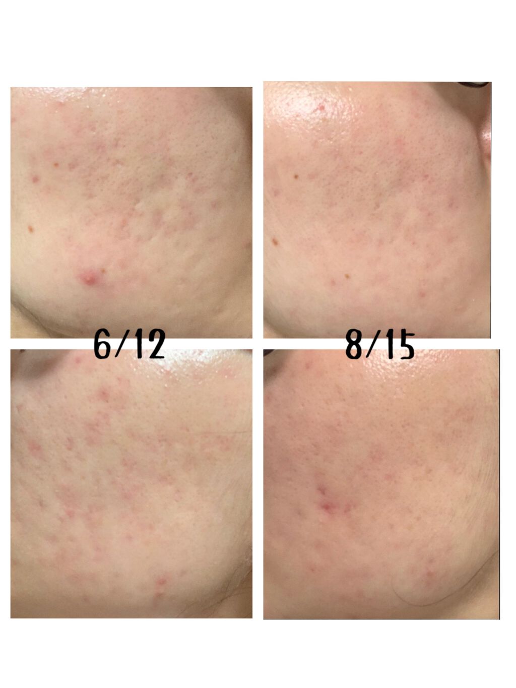 スキンピールバー ティートゥリー/サンソリット/洗顔石鹸を使ったクチコミ(2枚目)